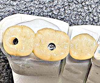 verschraubte Zirkonkronen mit Klebebasis auf Implantaten