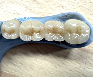 Zirkon-Seitenzahnkronen verblendet